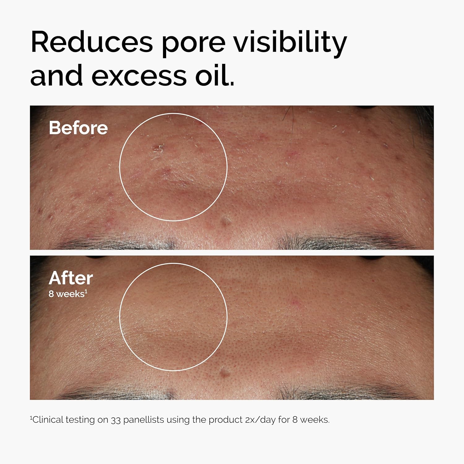 The Ordinary Niacinamide 10% + Zinc 1%, Smoothing Serum for Blemish-Prone Skin, 1 Fl Oz - Image 2