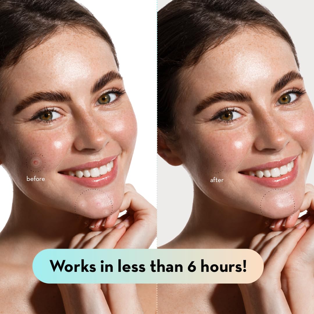 LE GUSHE Korean Pimple Patches for Face (132 Dots) - Hydrocolloid Acne Patches with Tea Tree Oil - Invisible Zit Stickers - Dermatologist Tested - Korean Skin Care - Image 4