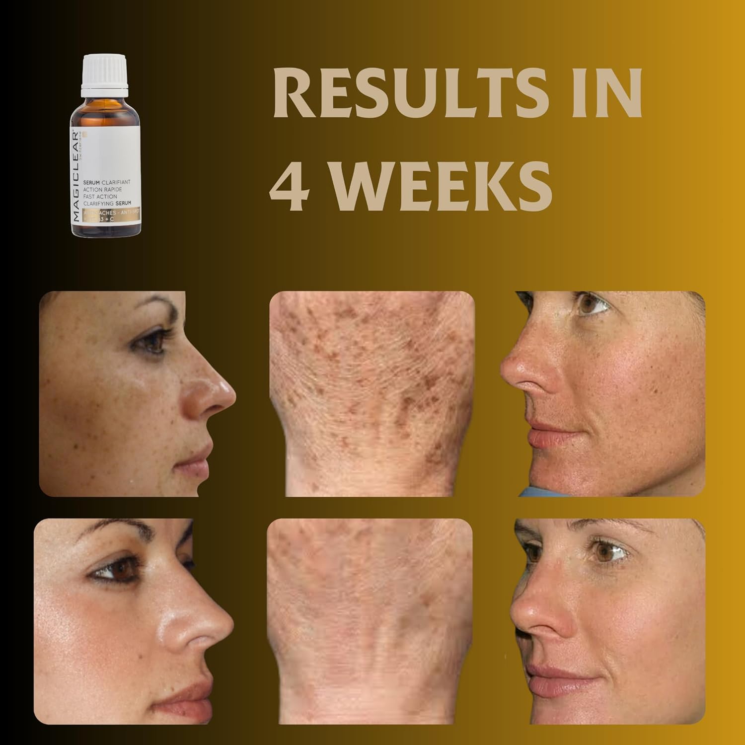 Luxury Swiss Dark Spot Remover for Face and Body Serum Gel Cream Age Sun Brown Spot Acne Freckles Corrector Melasma treatment Anti aging Skin Vitamin C + Niacinamide best organic brand Magiclear - Image 3