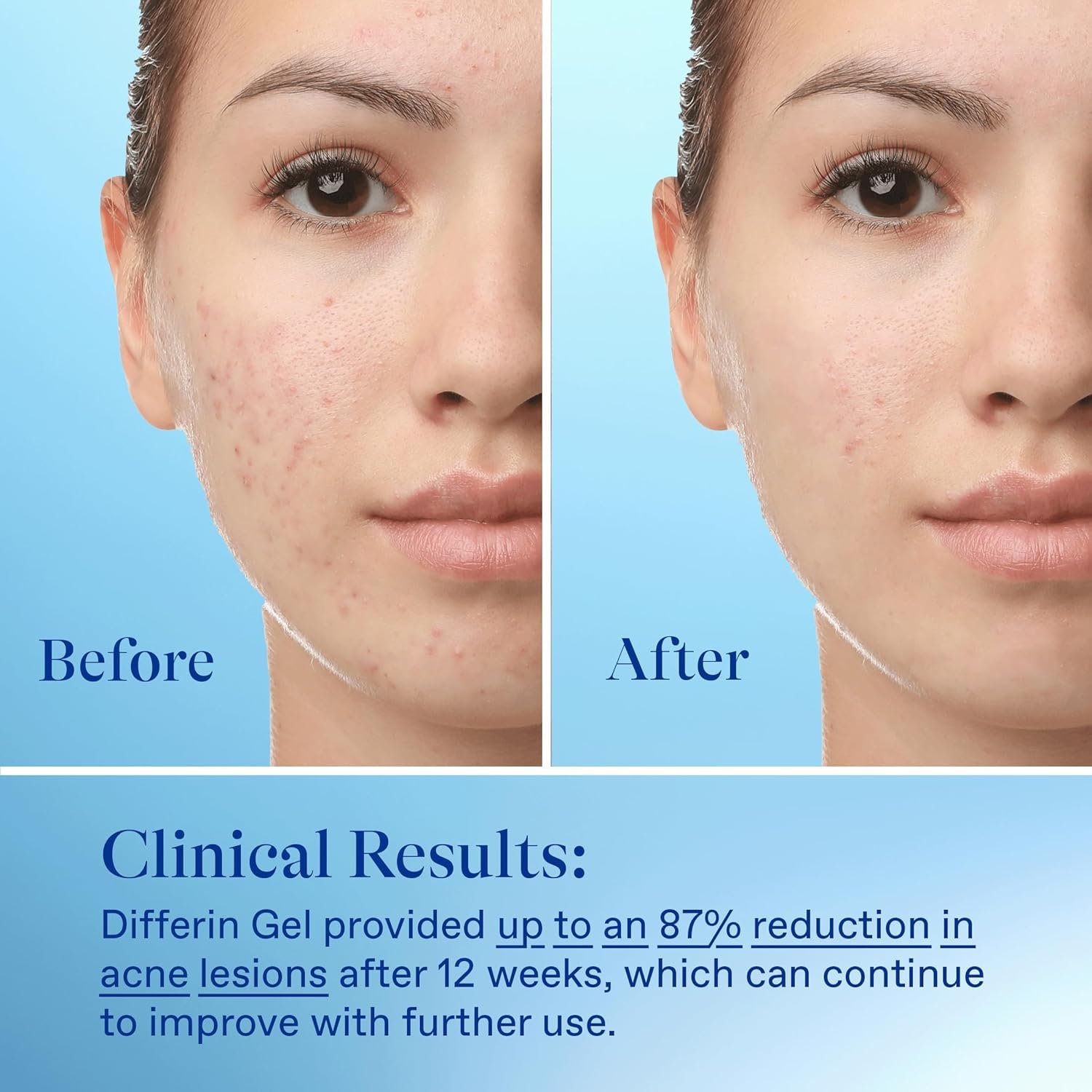 Differin Acne Treatment Gel, 30 Day Supply, Retinoid Treatment for Face with 0.1% Adapalene, Gentle Skin Care for Acne Prone Sensitive Skin, 15g Tube (Packaging May Vary) - Image 9