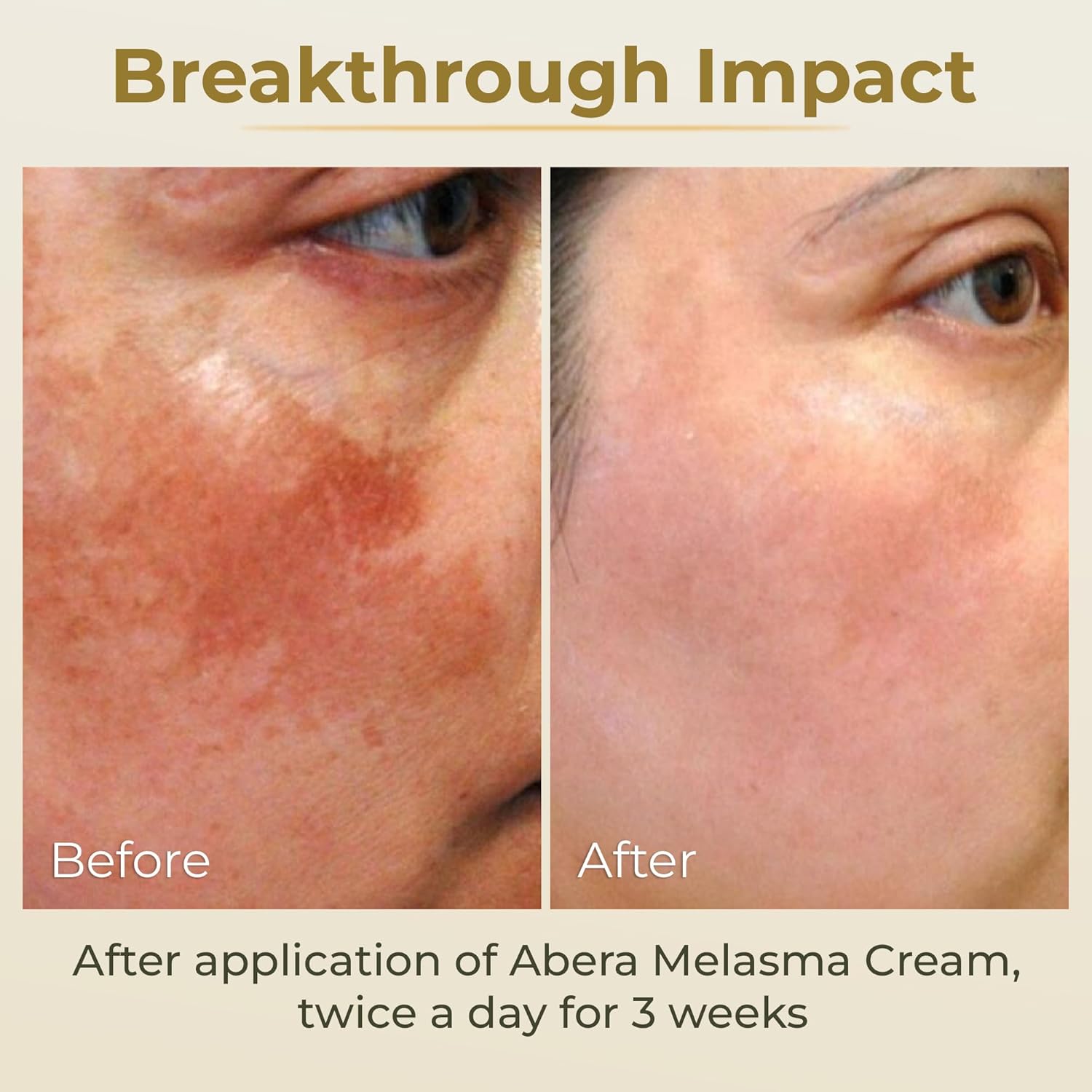 ABERA Melasma Cream (Premium Version) - Dark Spot Corrector, Melasma, Freckle, Sun Spot, Age Spot Remover Advanced Formula for Women and Men (0.7 Oz Per Item) - Image 4