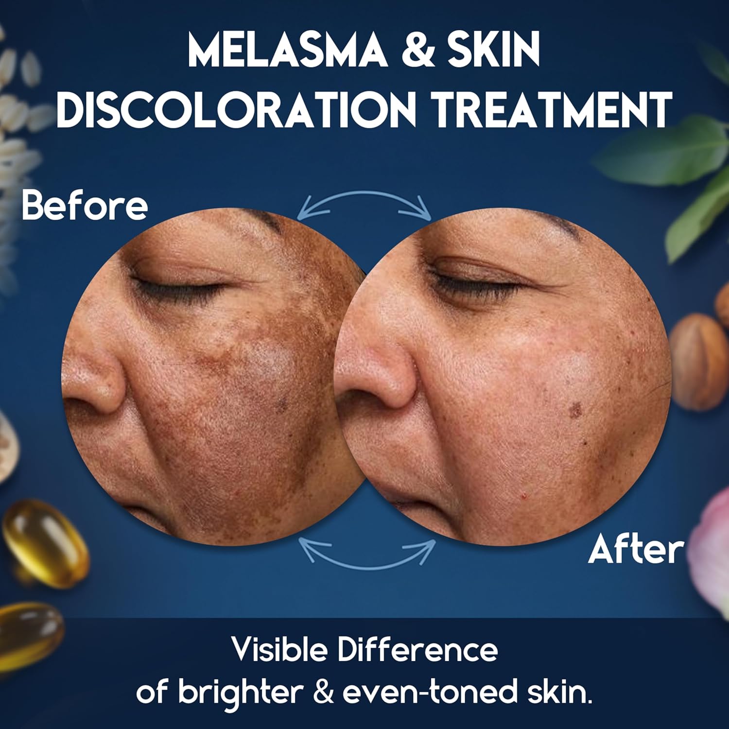 Melasma Treatment for Face - Melasma Cream & Age Spot Remover for Skin Discoloration, Post-Blemish Marks, Scars & Spots | Dark Spot Remover for Face & Body - Image 3